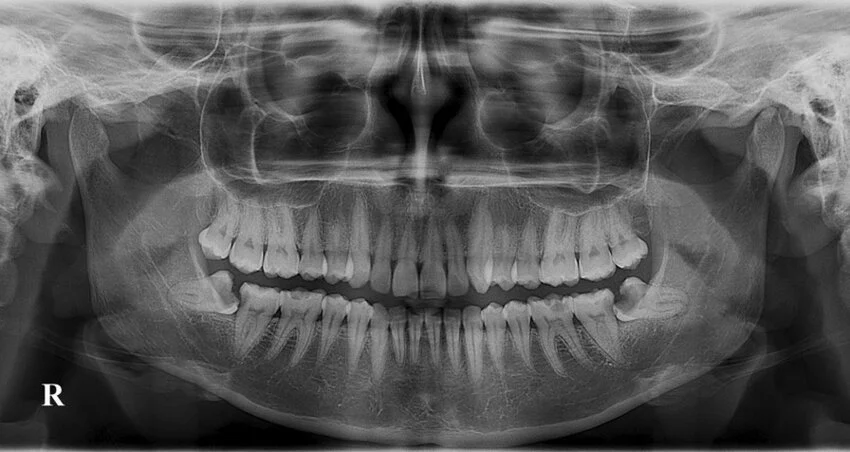 Real OPG Scan